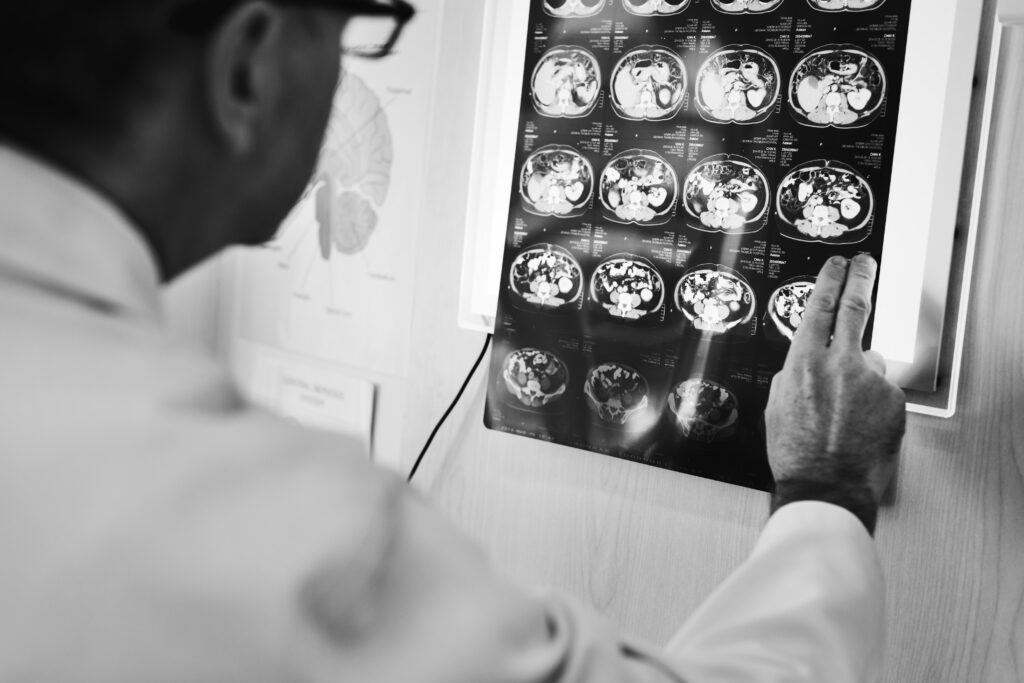 MENINGITIS, ENCEFALITIS Y OTRAS INFECCIONES DEL SISTEMA NERVIOSO CENTRAL (SNC): CONSECUENCIAS Y ABORDAJE TERAPÉUTICO